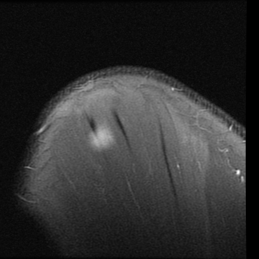 File:Full-thickness supraspinatus tear, HAGL and deficient ...