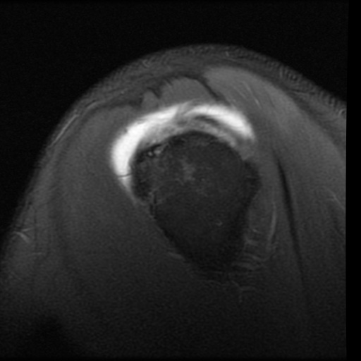 File:Full-thickness supraspinatus tear, HAGL and deficient ...