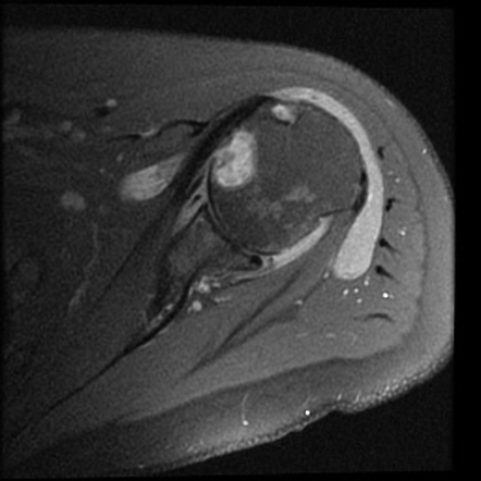 Rheumatoid arthritis (MRI shoulder) | Image | Radiopaedia.org