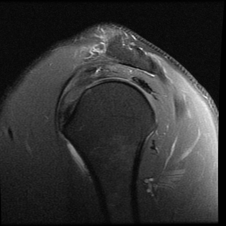 Full-thickness partial width supraspinatus tear | Image | Radiopaedia.org