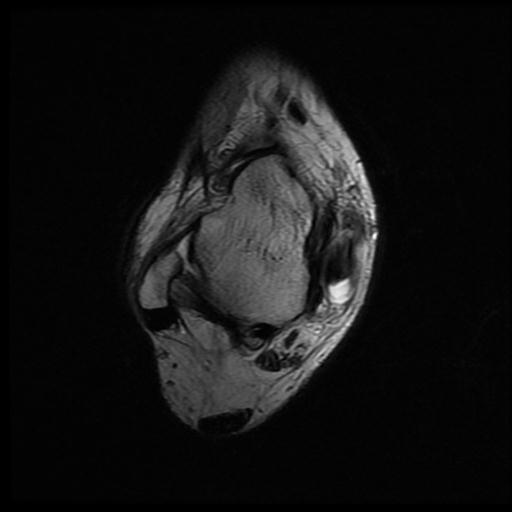 Tibialis Posterior Tenosynovitis 