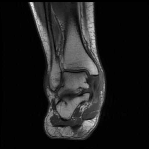 Tibialis posterior tenosynovitis | Image | Radiopaedia.org