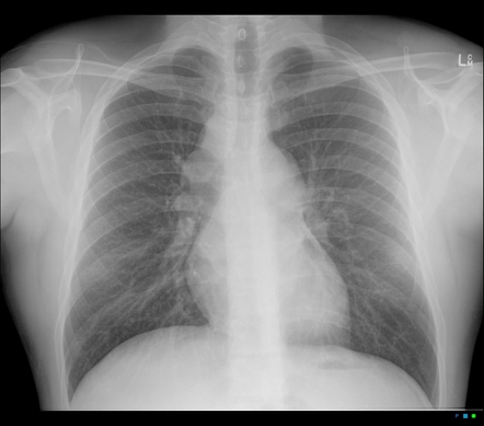 Lambda sign of sarcoidosis | Image | Radiopaedia.org