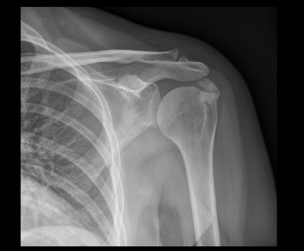 Rotator cuff calcific tendinopathy | Radiology Case | Radiopaedia.org