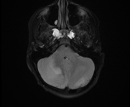 Acute cerebellitis | Radiology Reference Article | Radiopaedia.org