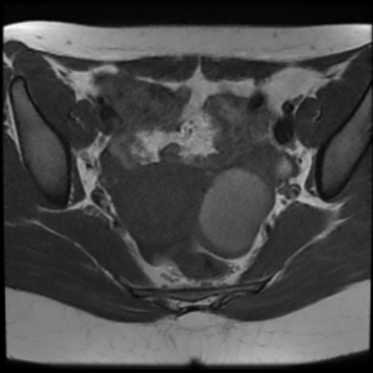 Hemorrhagic Ovarian Cyst Image 1783