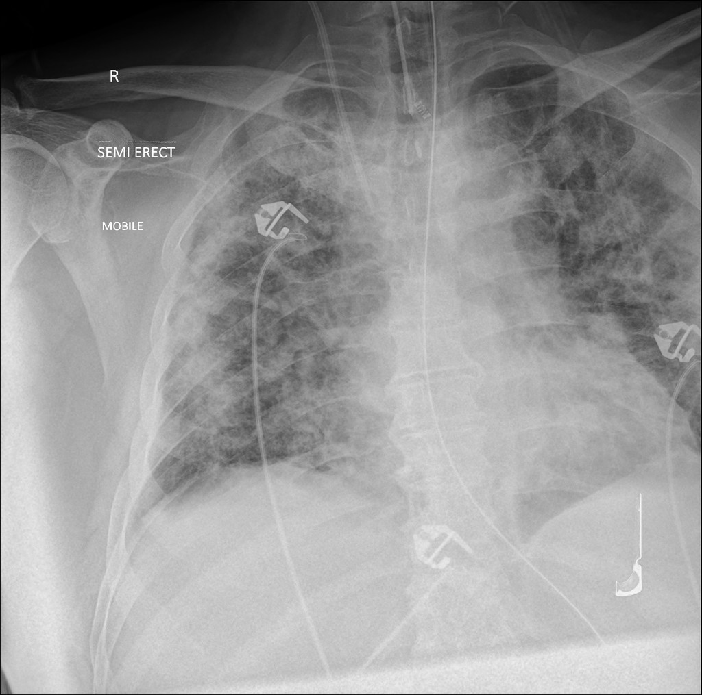 Covid 19 Pneumonia Progression And Regression Radiology Case