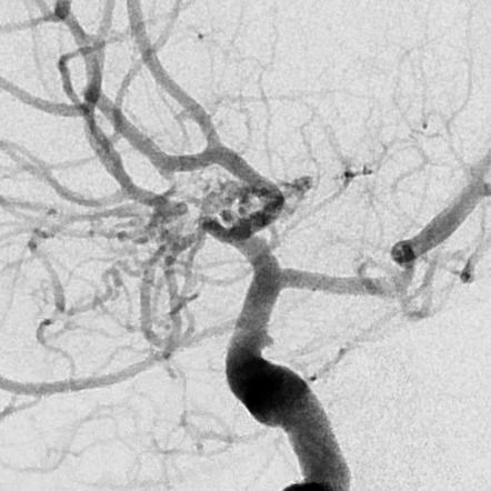 Twig Like Middle Cerebral Artery Radiology Reference Article