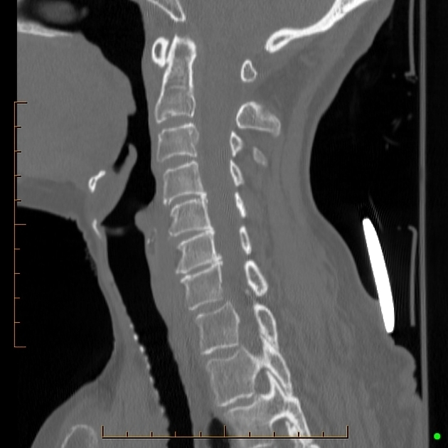 type 3 odontoid fracture