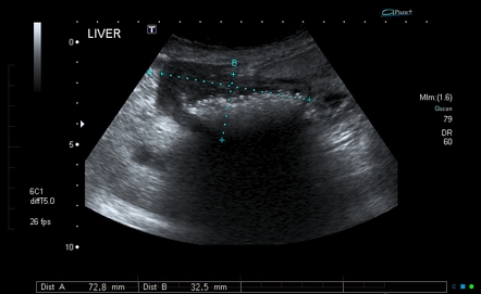 Acute cholecystitis with common bile duct stones | Image | Radiopaedia.org