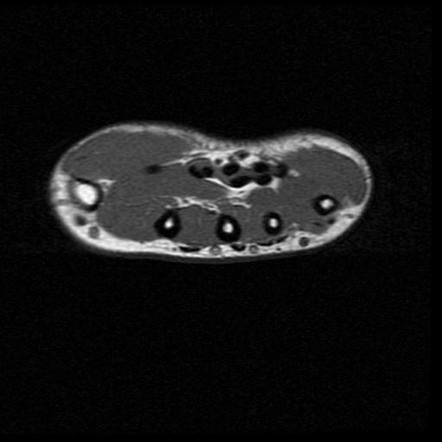 Flexor Tendon Tenosynovitis - Index Finger | Radiology Case ...