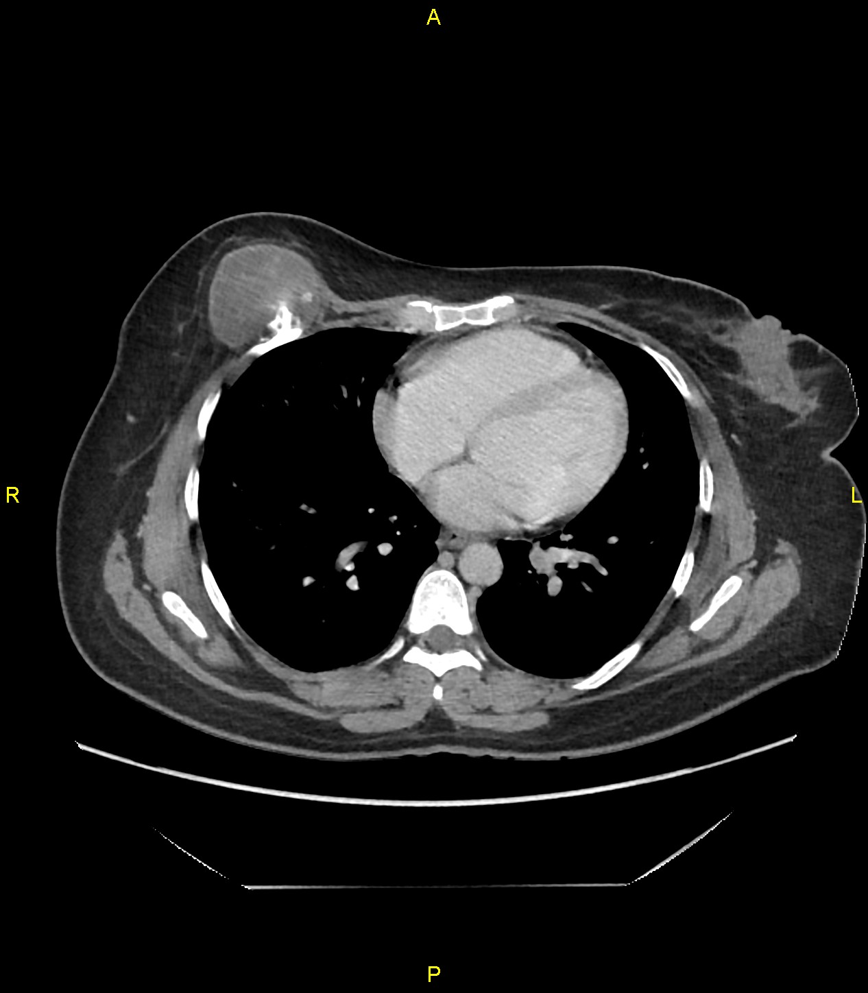 Low-grade chondrosarcoma | Image | Radiopaedia.org