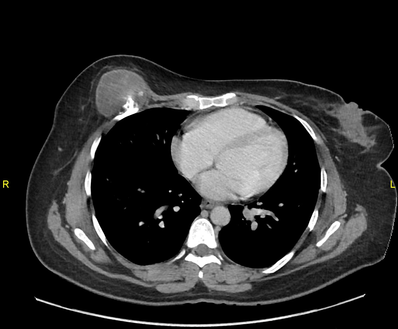 Low-grade chondrosarcoma | Image | Radiopaedia.org