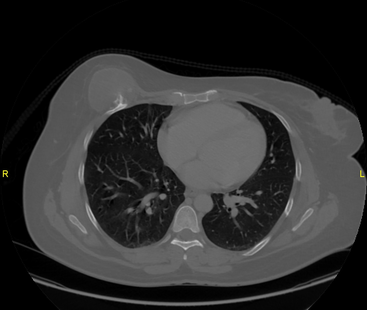 Low-grade chondrosarcoma | Image | Radiopaedia.org