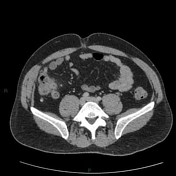 Featured image of post Appendicitis Ultrasound Radiopaedia Details of the image modality