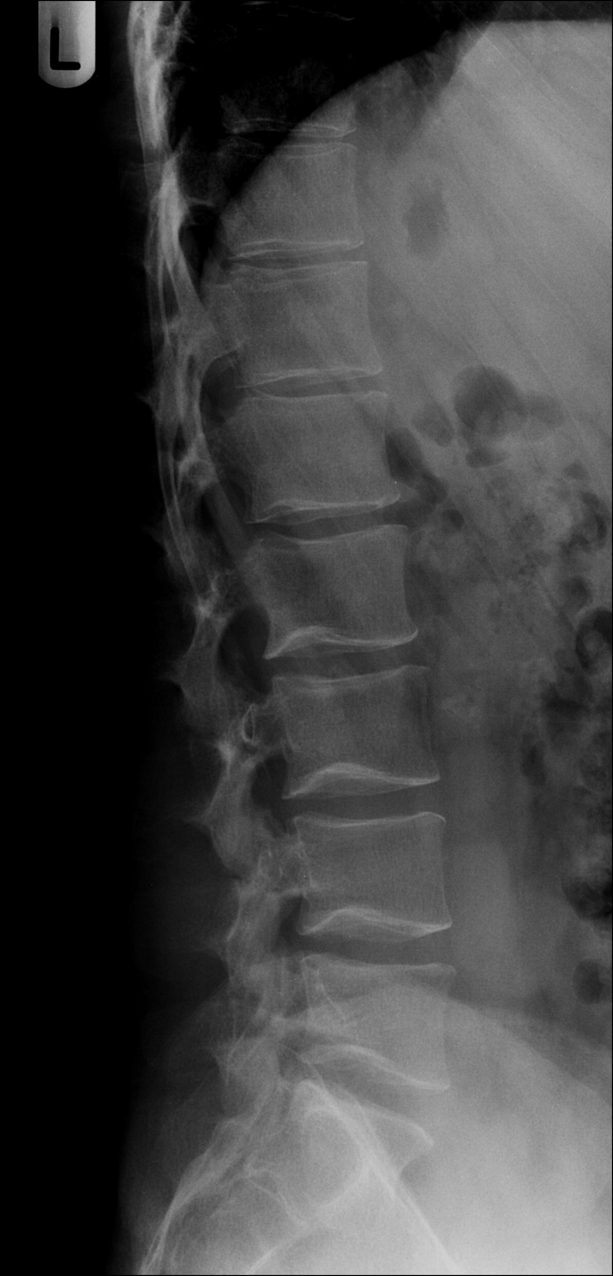 Spinal myxopapillary ependymoma - large | Image | Radiopaedia.org