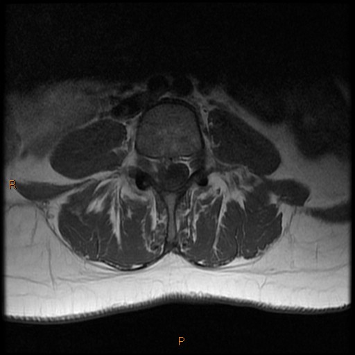 L4/5 disc subarticular extrusion | Image | Radiopaedia.org