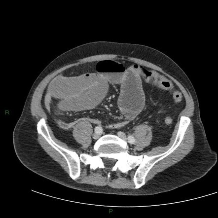 Small bowel obstruction due to an internal hernia | Radiology Case ...