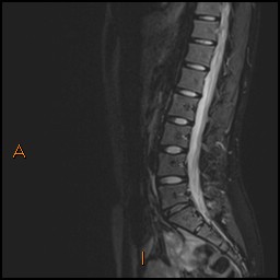 Bilateral L4 pars defects | Image | Radiopaedia.org