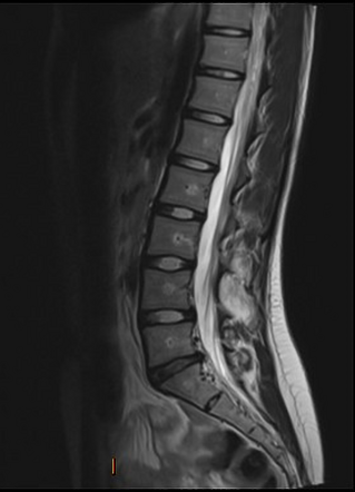 Bilateral L4 pars defects | Image | Radiopaedia.org