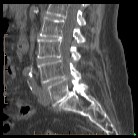 Sacral insufficiency fracture | Image | Radiopaedia.org