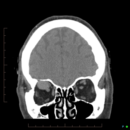 Orbital Venous Varix Radiology Reference Article Radiopaedia Org | Hot ...