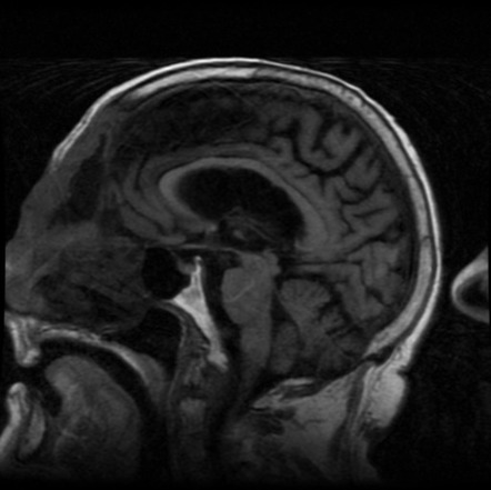 Nasal squamous cell carcinoma | Image | Radiopaedia.org