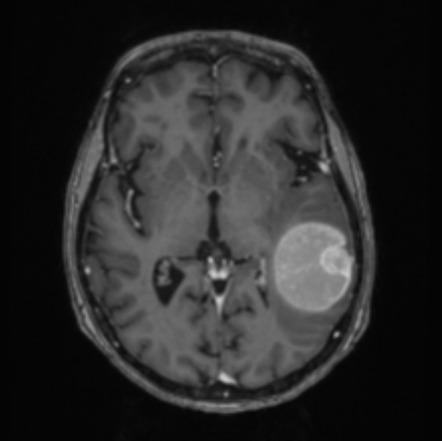 Hemorrhagic intracranial melanoma metastasis | Image | Radiopaedia.org