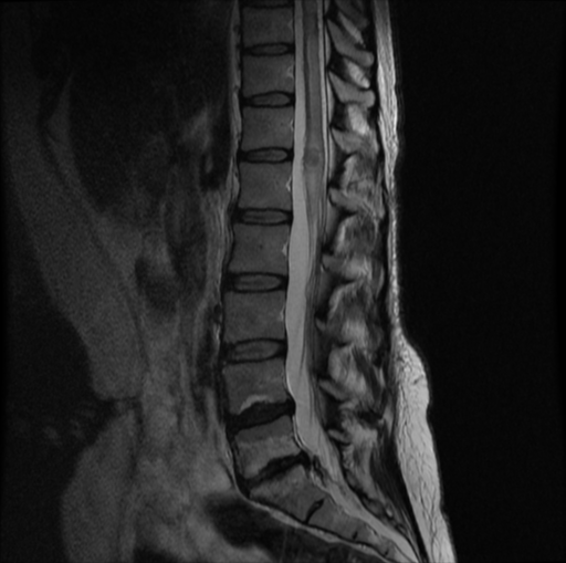 Intramedullary spinal cord metastasis | Image | Radiopaedia.org