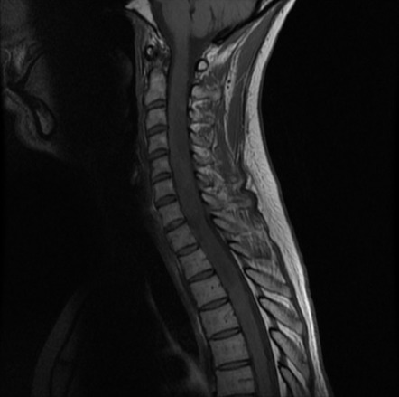 Intramedullary spinal cord metastasis | Image | Radiopaedia.org