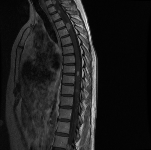 Intramedullary spinal cord metastasis | Image | Radiopaedia.org