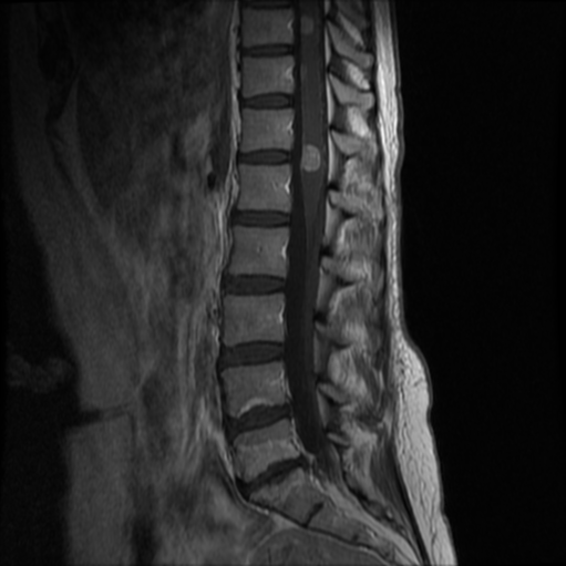 Intramedullary spinal cord metastasis | Image | Radiopaedia.org