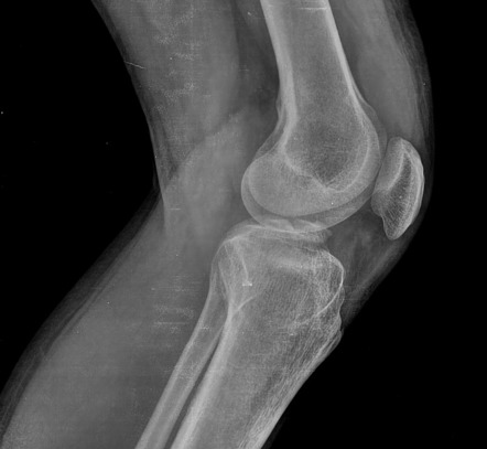 ACL avulsion fracture | Radiology Case | Radiopaedia.org