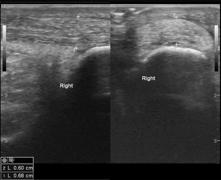 Achilles Tendinosis And Tear | Image | Radiopaedia.org