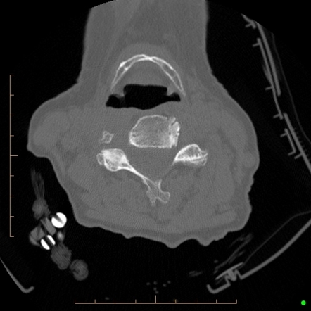 Type III Odontoid fracture | Image | Radiopaedia.org