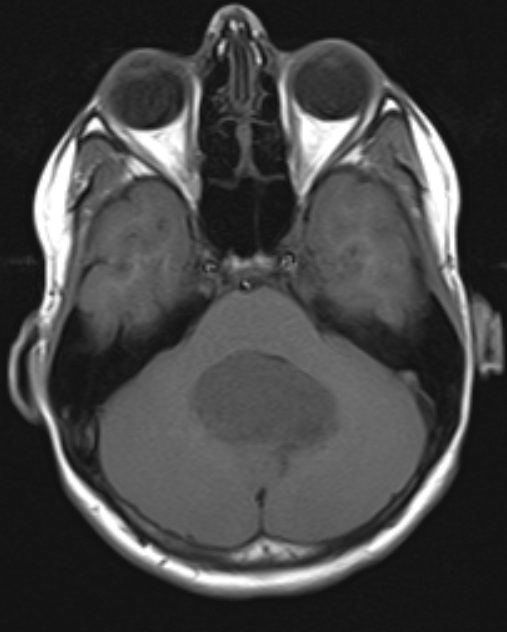 Childhood Medulloblastoma - Pictures