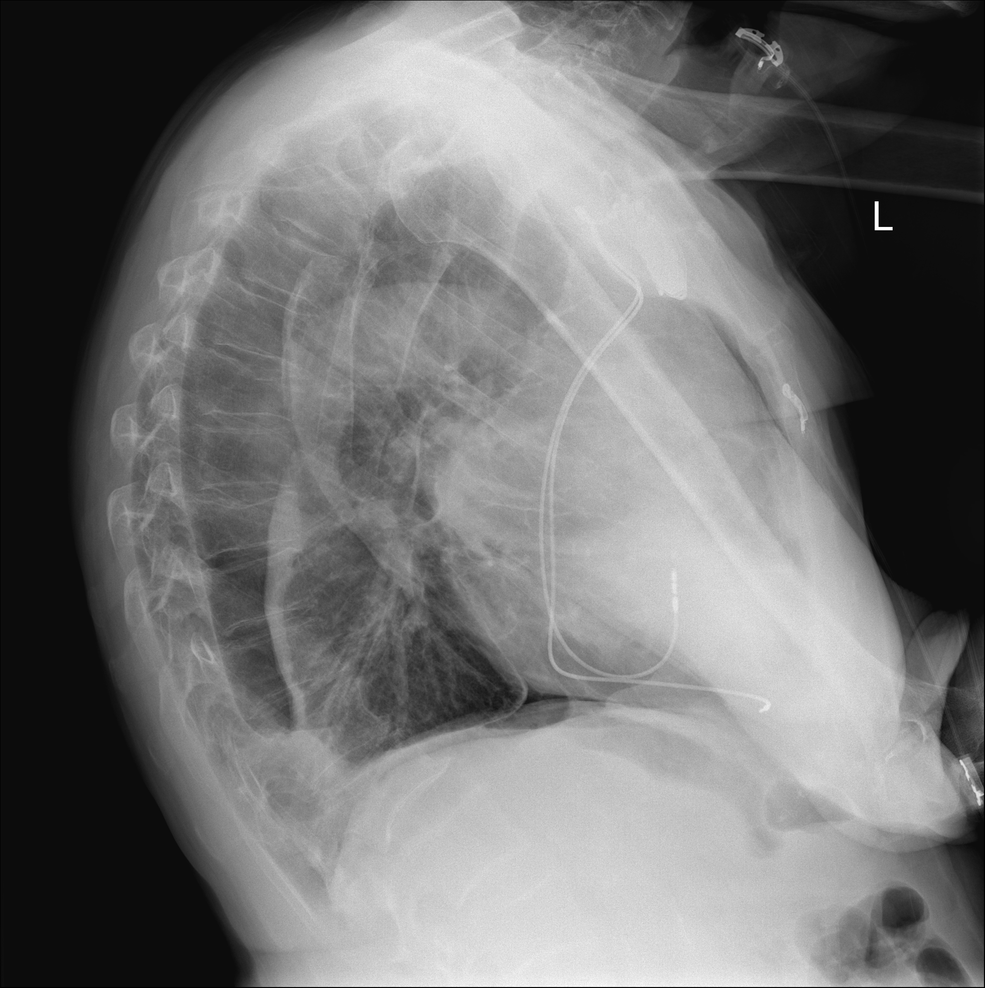 Iatrogenic Pneumothorax | Image | Radiopaedia.org