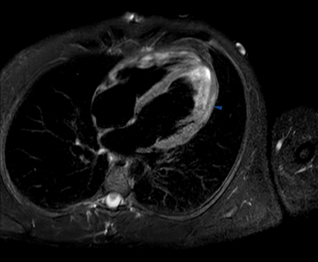 Acute Myocarditis Mri - The Role Of Cardiovascular Magnetic Resonance ...