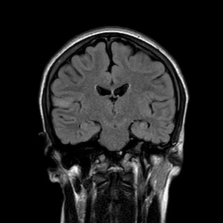 Focal cortical dysplasia | Image | Radiopaedia.org