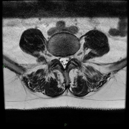 3D fast spin echo (MRI sequence) | Radiology Reference Article ...