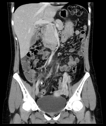 Perforated acute appendicitis | Radiology Case | Radiopaedia.org