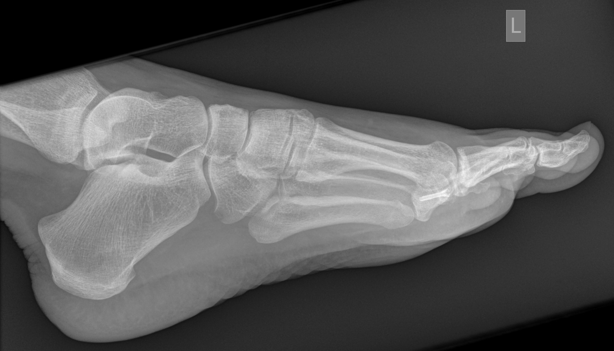 Bipartite hallux sesamoid diastasis | Image | Radiopaedia.org