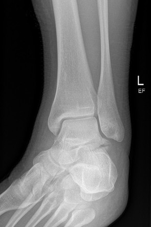 Weber Classification Of Ankle Fractures | Radiology Reference Article ...