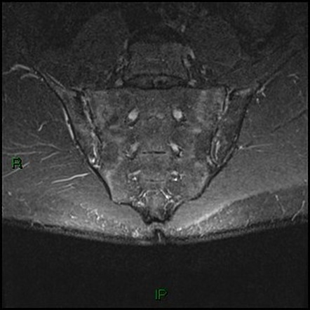 Sacroiliitis (differential) | Radiology Reference Article | Radiopaedia.org