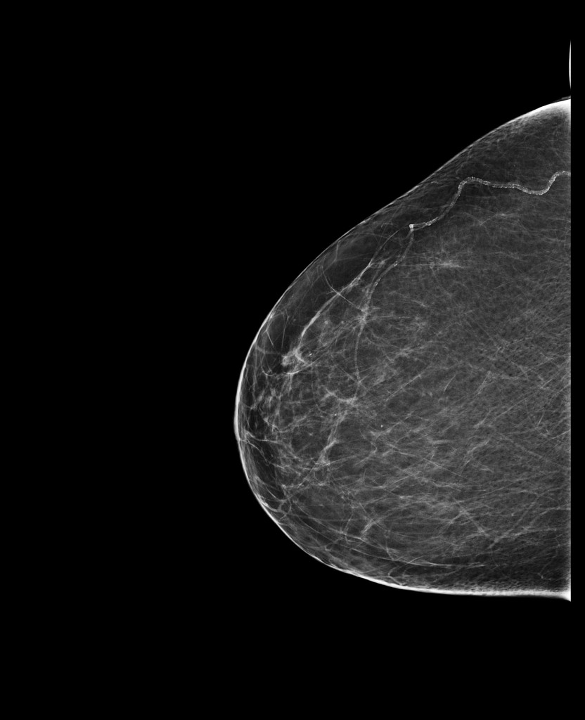 Featured image of post Radiopaedia Mammography