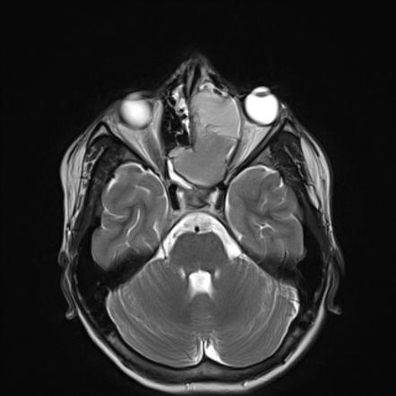 Frontoethmoidal mucocele | Radiology Reference Article | Radiopaedia.org