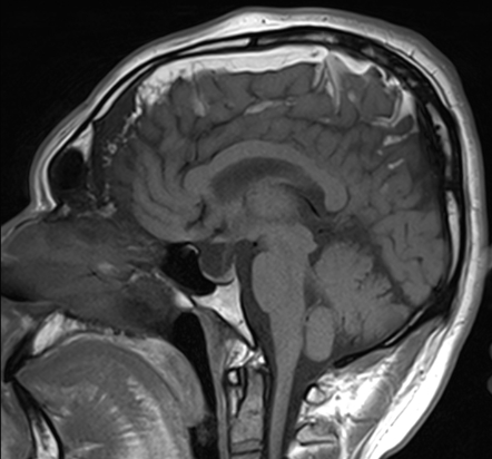 Sturge-Weber syndrome | Radiology Case | Radiopaedia.org