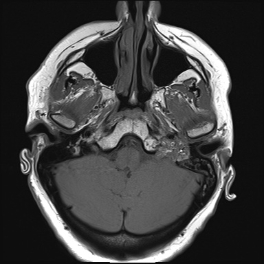 Glomus Jugulotympanicum Paraganglioma 