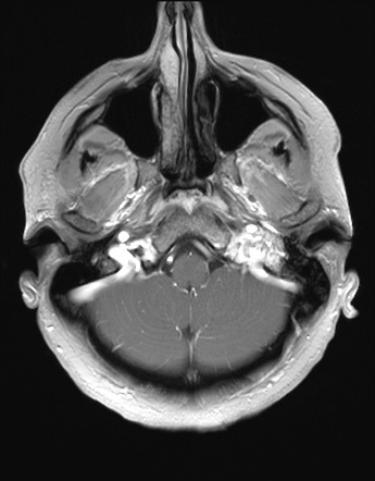 Glomus jugulotympanicum paraganglioma | Image | Radiopaedia.org