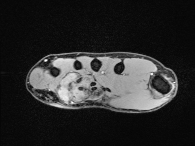 Giant cell tumor of the tendon sheath | Image | Radiopaedia.org